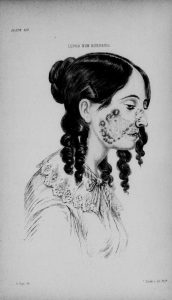 Black and white illustration of a fashionably dressed young woman with a severe skin inflammation over cheek and nose