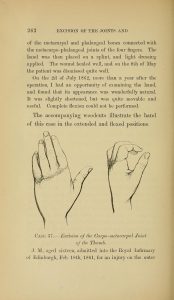 Two illustrations of possible malformations of the human hand