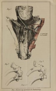 Illustrations of a case of traumatic hemorrhage following tracheotomy