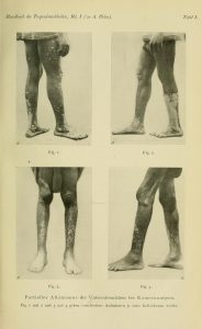 Four black and white patient photographs from a German manual on tropical diseases