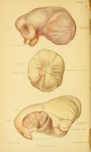 Full page color illustration of three tubal pregnancies