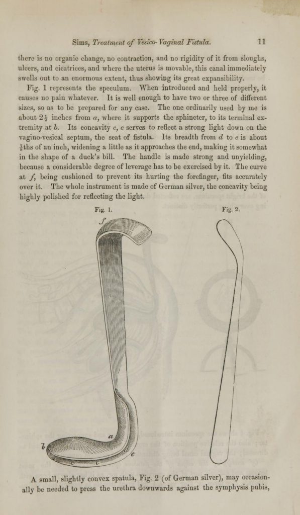 Page from J Marion Sims's 1853 "On the treatment of vesico-vaginal fistula" showing two different views of a simple speculum for vaginal examination.